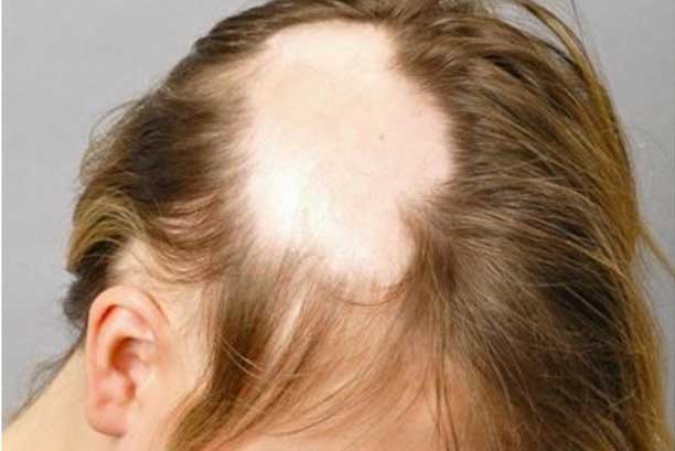 Alopecia areata causes & symptoms