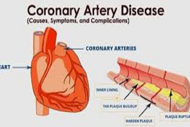 Coronary artery disease