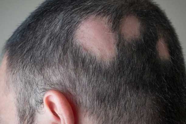 Sudden loss of hair patches