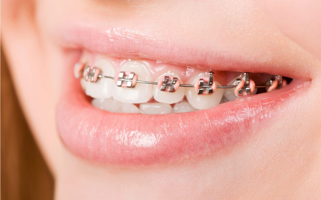 A Guide to Permanent Retainers after Braces