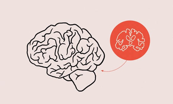 brain affected