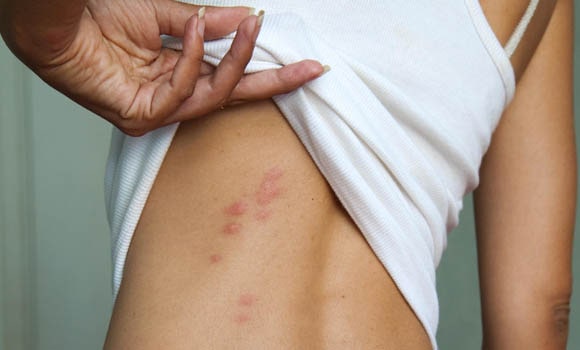 skin rashes