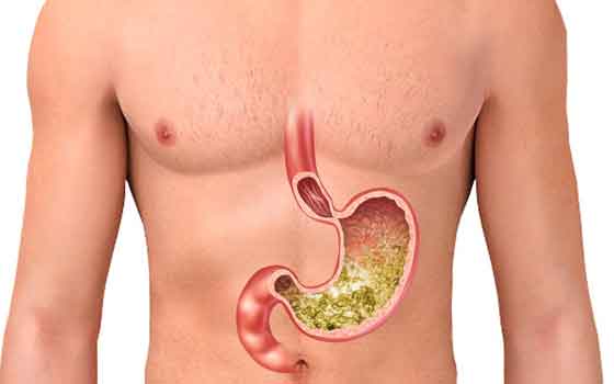 Counteracting Stomach Acid