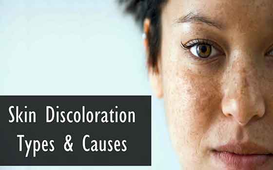 Skin Discoloration Types Causes Treatment And Much More Health