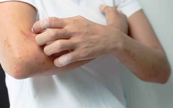 Atopic Dermatitis