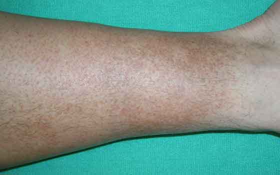 Brown Skin Discoloration On Lower Legs Ankles Face And Neck Wellness