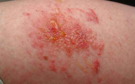 Contact Dermatitis