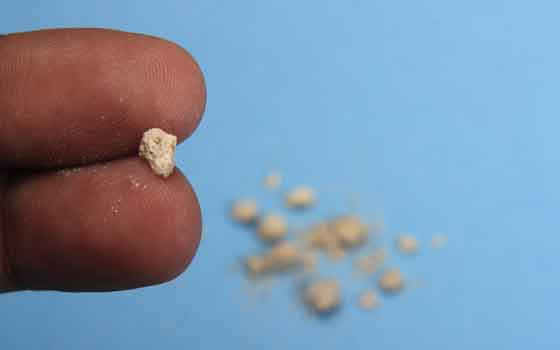 Kidney Stone