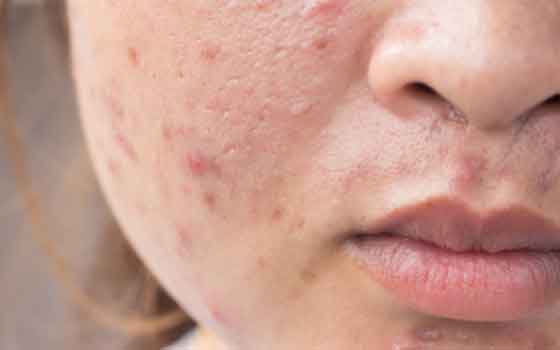 Calendula oil for acne