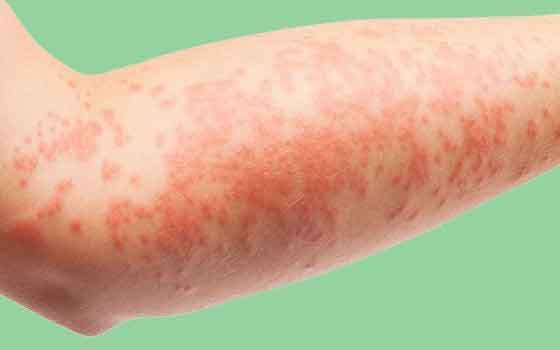 eczema