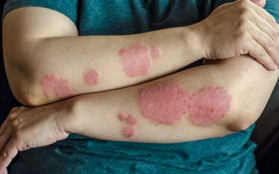 psoriasis