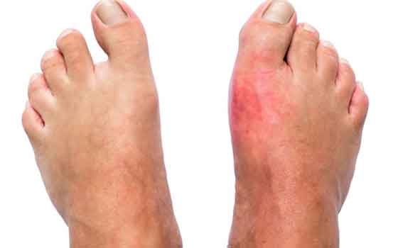 Acute gout