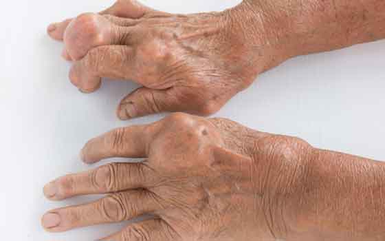 Asymptomatic hyperuricemia