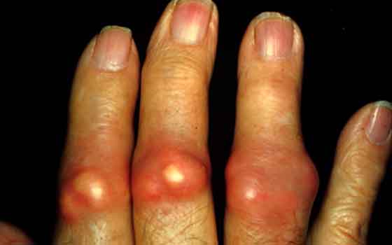 Chronic tophaceous gout