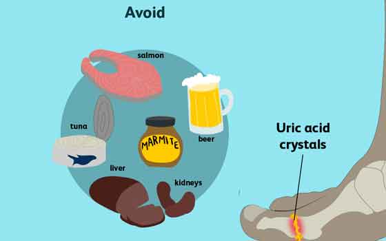foods and drinks Gout patients should avoid
