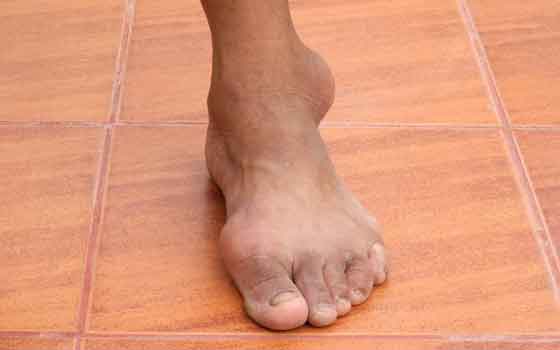 intercortical gout