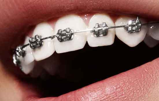 Teeth Brace