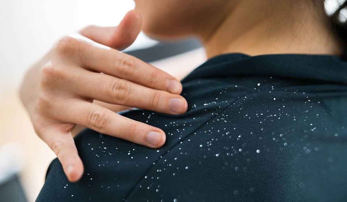 House therapies to cut back dandruff briefly