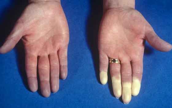 Raynaud’s disease 